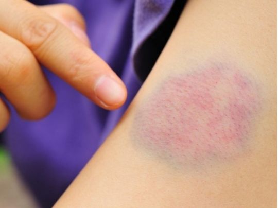 Як швидко позбутися синця: прості та дієві способи
