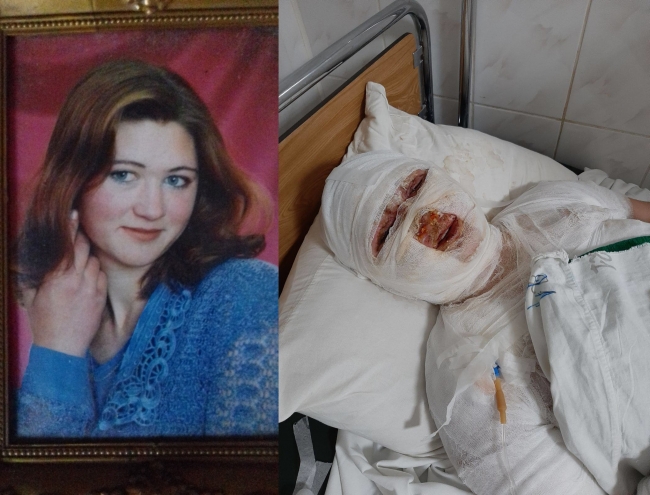Збирають допомогу жінці, яка сильно обгоріла, розпалюючи грубку