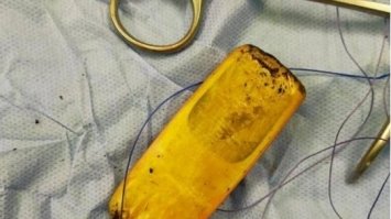 Чоловік прожив півроку з мобільним телефоном у шлунку